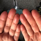 Die Haut auf den Fingern wird dünn
